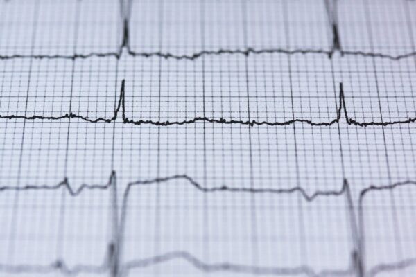 electrocardiograma 12 derivaciones