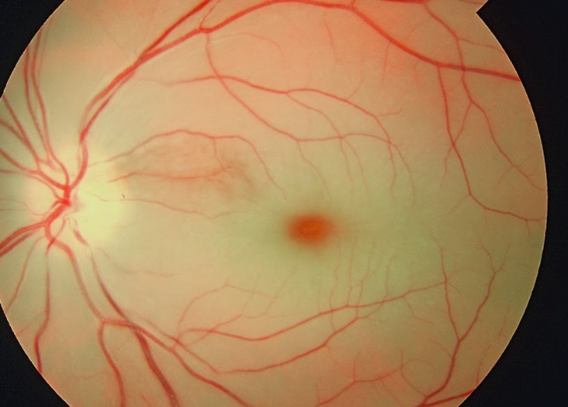 oclusión arteria central retina